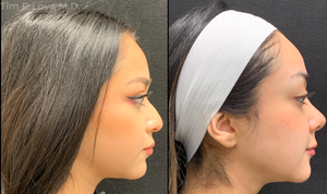 Patient is 1 year post-op.-before