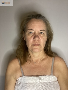 After 1 MN session-before