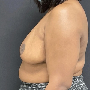 Breast Reduction #1-after