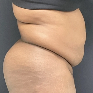 Tummy Tuck #8-before