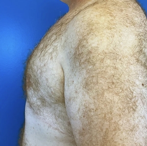 Male Breast Reduction #3-after