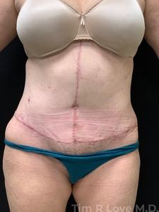 Abdominoplasty - Traditional-after