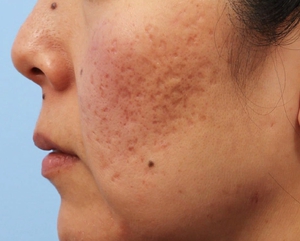 Post Acne Scars-before
