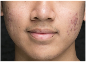 Post Acne Scars-before