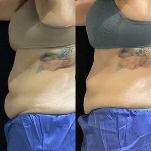 CoolSculpting 2-Treatments-before