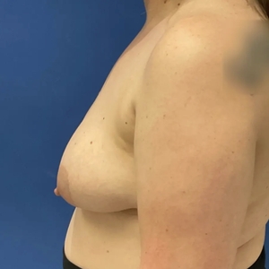 Breast Lift #1 (left)-before