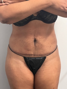 LAL-upper + lower abdomen + mini tummy tuck-after