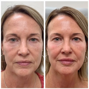 Botox-before
