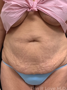 Abdominoplasty - Traditional-before