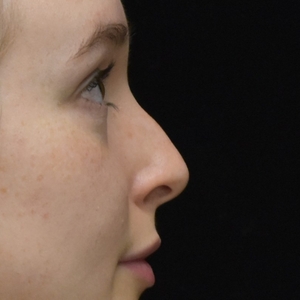 Liquid Rhinoplasty (filler)-before