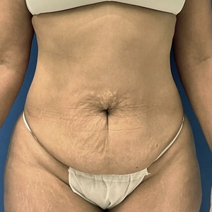 Tummy Tuk #3 (front)-before