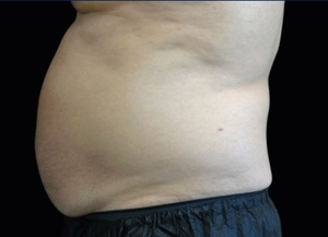 Emsculpt NEO #5-before