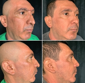 Closed Reduction Rhinoplasty:-before