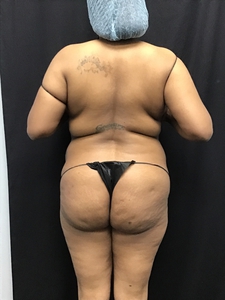 Lipo 360 + BBL-after