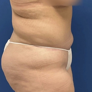 Tummy Tuck #14-after