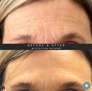 Botox-before