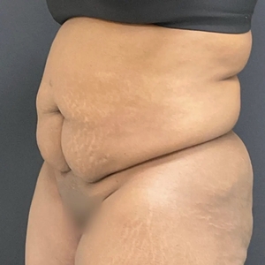 Tummy Tuck #8-before