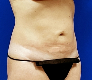 Liposuction #2-after