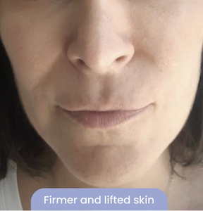 Fine Line & Aging Skin-after