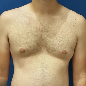 Male Breast Reduction #5-before