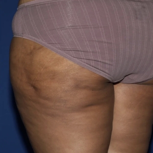 Cellulite Reduction #2-after