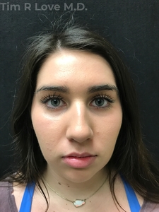 3 Months Post Op-before