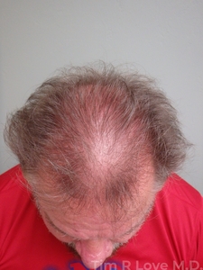 2000 grafts-before