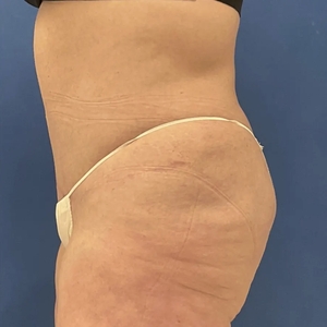 Tummy Tuck #1-after