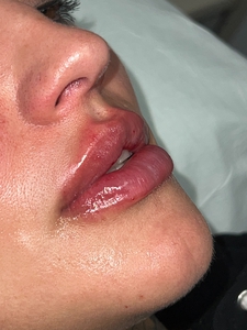 Lip Filler-before