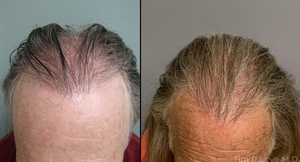 1700 Hair Grafts-before