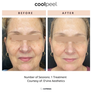 Coolpeel-before