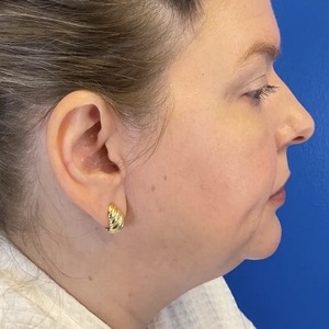 Lipo w Skin Tightening Face #8-before