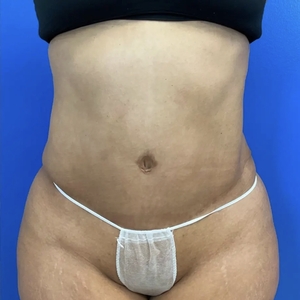 Tummy Tuck #2-after