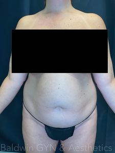 LIPO 2.0-before