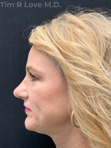 1 month post op traditional rhinoplasty-after