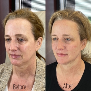 Filler B/A SBA 32-before