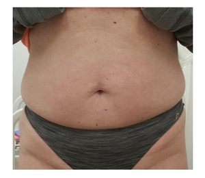 Body Contouring-after