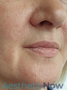 Laser Resurfacing-before