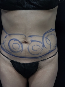 LAL-lower abdomen + waist-before