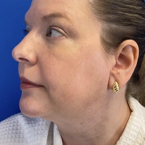 Lipo w Skin Tightening Face #8-before