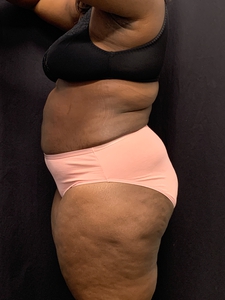 Lipo 360 + mini tummy tuck-after