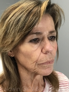 LOWER FACE-before