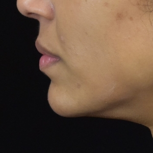 Chin Filler-after