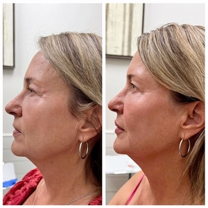 Botox-before