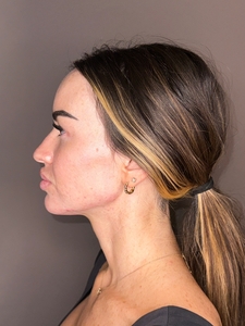Demeri Cobb- Facial Balancing Side-before