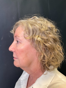 NECK AND LOWER FACE-after