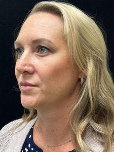 1 syringe Restylane Kysse in lips-before