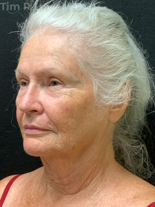 1 year post op short scar face lift, lip lift,  MyEllevate, FaceTite, Morpheus8, Sculptra, and lip filler-before