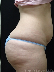 BodyTite - Abdomen-before