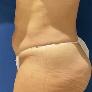 Tummy Tuck #5-before